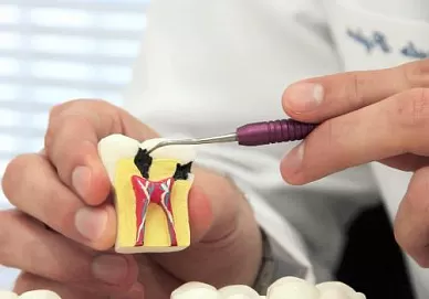 Лечение каналов зубов